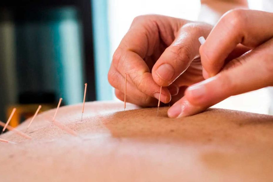 poner acupuntura a paciente